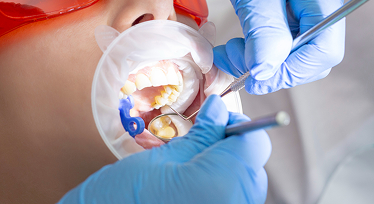 Root Canal
