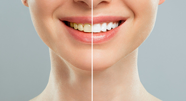 Teeth Whitening