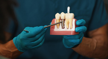 Dental Implants