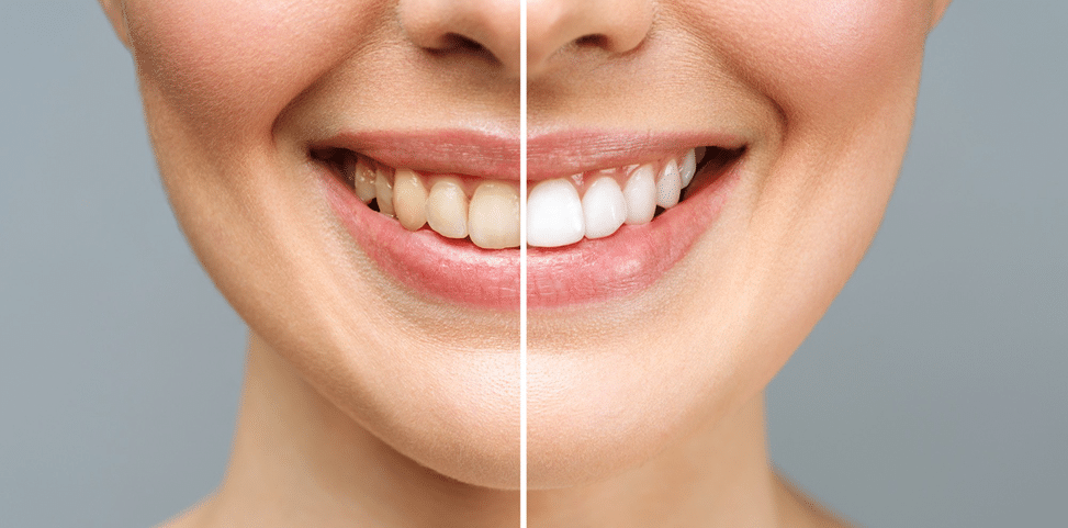 Before and after comparison of teeth whitening results showing improved tooth colour and a brighter smile in Tarneit